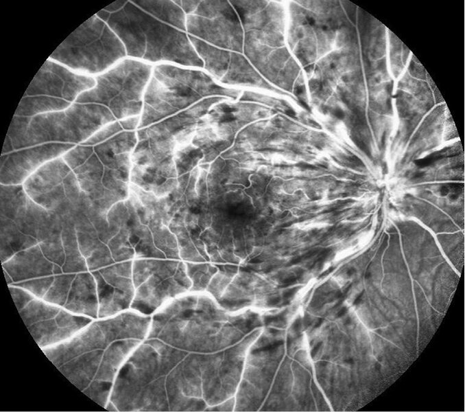 Rycina 5. Angiografia fluoresceinowa. Zakrzep żyły centralnej siatkówki, późna faza żylna. Poszerzone łożysko żylne, hipofluorescencja w miejscach krwotoczków
