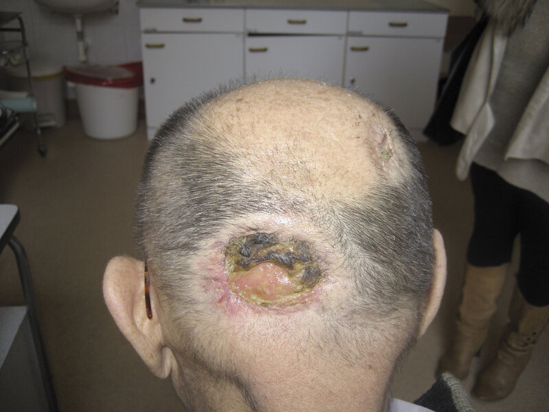 Ryc. 3. Owrzodzenie w przebiegu pyoderma gangrenosum – różnicowanie z chłoniakiem Hodgkina (wątpliwości histopatologiczne).