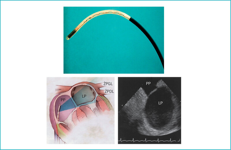 Rycina 10. Ultrasonografia wewnątrzsercowa znacznie ułatwiła procedury ablacji prądem o częstotliwości radiowej. U góry: sonda liniowa typu phased array. Po lewej: umieszczenie cewnika w prawym przedsionku (PP) pozwala na uwidocznienie ujść żył płucnych lewego przedsionka (z prawej) bez potrzeby wprowadzania drugiego cewnika do lewego przedsionka (LP). ŻPDL – żyła płucna dolna lewa; ŻPGL – żyła płucna górna lewa. 