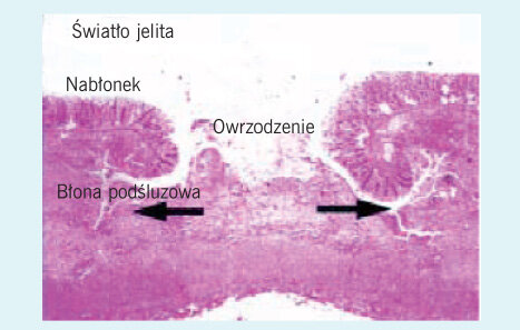  Rycina 1. Owrzodzenie w kształcie butelki w inwazyjnej pełzakowicy jelitowej (barwienie hematoksyliną-eozyną, oryginalne powiększenie × 50). Szczyt owrzodzenia od strony światła jelita jest węższy niż jego podstawa, tworząc kształt butelki. Jest to skupisko trofozoitów w błonie śluzowej przechodzące na boki do błony podśluzowej (kierunek powiększania się owrzodzenia jest zaznaczony strzałkami). Mikroskopowo trofozoity są zlokalizowane na pogłębionych końcach podśluzówkowego owrzodzenia.