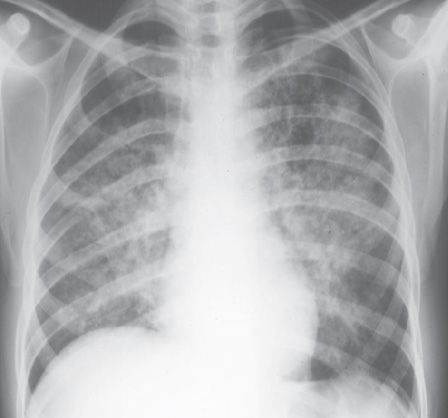  Rycina 2. Zdjęcie rentgenowskie przedstawiające typowe rozlane nacieki płucne w przebiegu pneumocystozowego zapalenia płuc