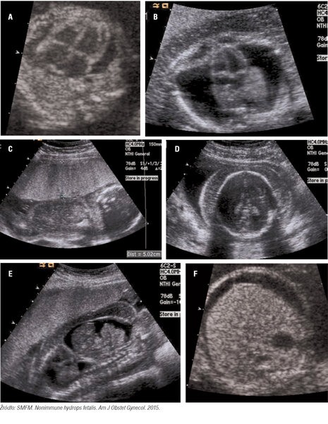 Rycina 1. Objawy stwierdzane w&nbsp;badaniu USG w&nbsp;przypadku nieimmunologicznego obrzęku płodu