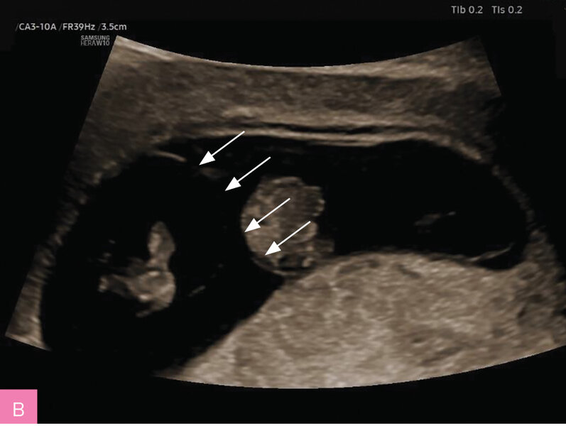 Rycina 1A, B. Badanie ultrasonograficzne wykonane w I trymestrze ciąży. A. Ciąża bliźniacza dwukosmówkowa dwuowodniowa, płody są oddzielone grubą warstwą 2 błon kosmówki i 2 błon owodni (objaw λ). B. Ciąża bliźniacza jednokosmówkowa dwuowodniowa, płody są oddzielone tylko 2 cienkimi warstwami owodniowymi (objaw τ)
