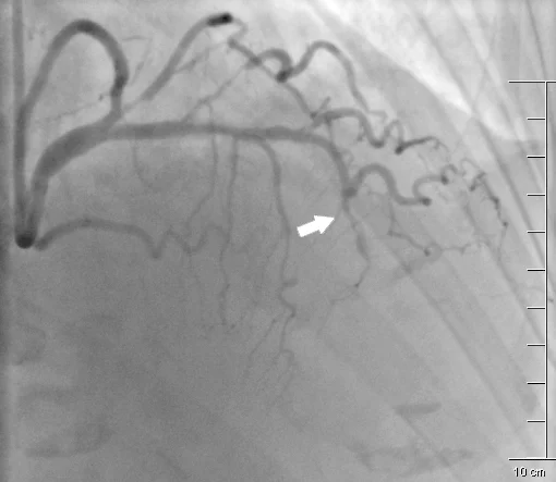 Rycina 1. Angiogram lewej tętnicy wieńcowej przedstawiający ostre zamknięcie gałęzi przedniej zstępującej. Miejsce niedrożności oznaczono strzałką.