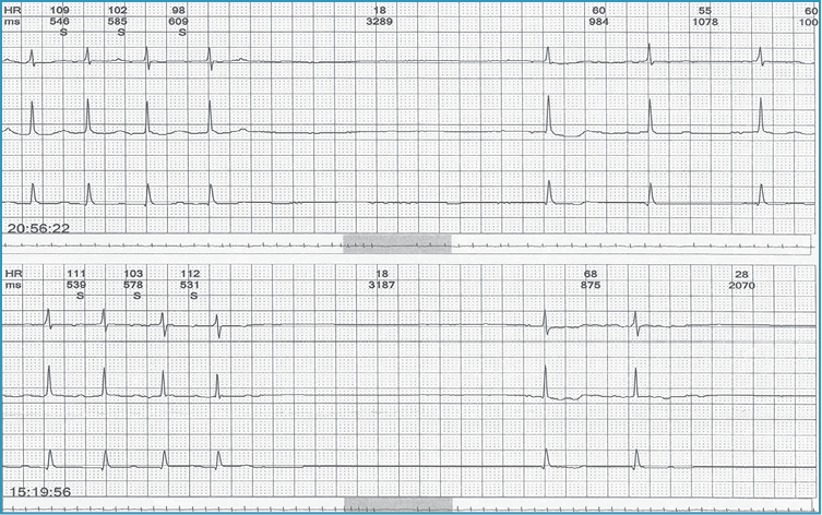 Rycina 1. Rejestracja EKG metodą Holtera u pacjenta z zespołem tachykardia-bradykardia i zasłabnięciami. Po zakończeniu napaduczęstoskurczu przedsionkowego następuje asystolia 3,3 sek (godz. 20.56.22) i 3,2 sek. (godz. 15.19.56) w mechanizmie zahamowania zatokowego