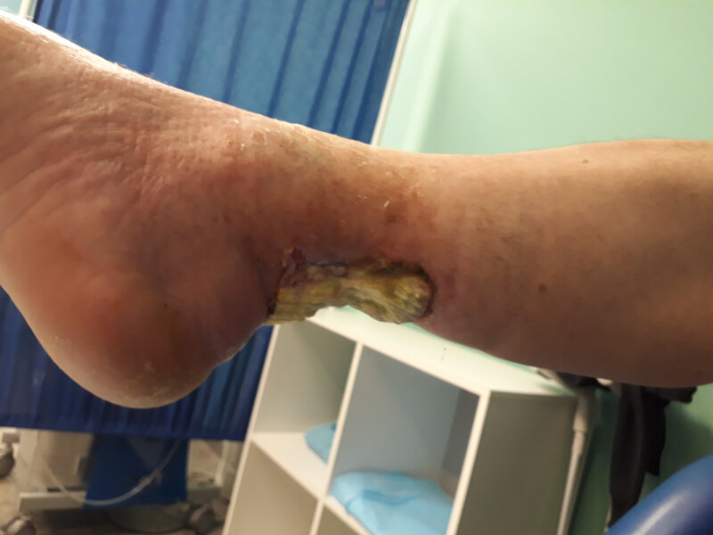 Rycina 2. Okolica prawego stawu skokowego. Strona przyśrodkowa. Radioterapia 45 lat temu z powodu hemangioendothelioma dystalnego odcinka piszczeli. Stan po leczeniu ropnia (zakażonego krwiaka) okolicy ścięgna Achillesa. Ubytek skóry i tkanki podskórnej przed chirurgicznym usunięciem części zmian martwiczych ścięgna Achillesa. Obraz 6 tygodni po ostatnim opatrunku typu VAC