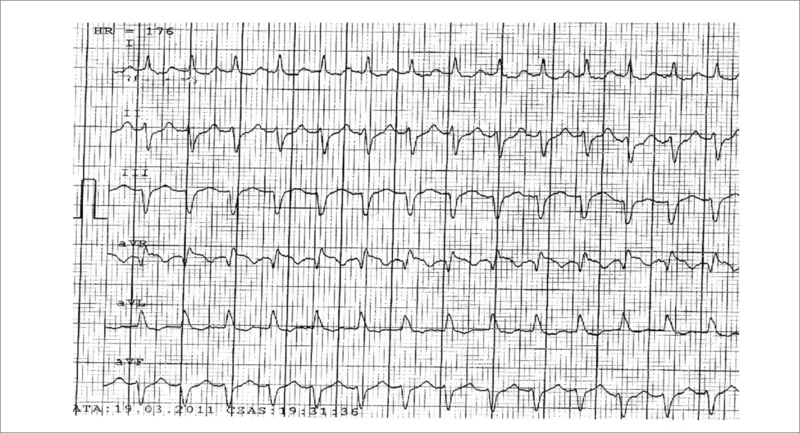 Rycina 5. Uniesienie ST w aVR w EKG 29-letniej pacjentki z częstoskurczem z wąskimi zespołami QRS – najprawdopodobniej AVRT.