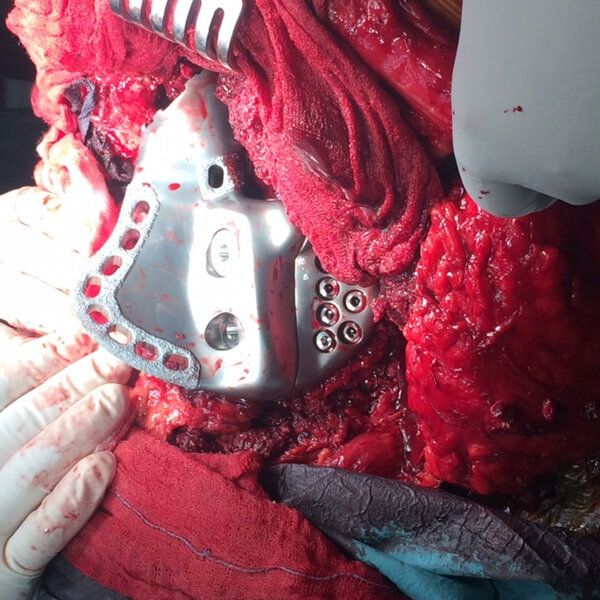 Ryc. 2. Implant po osadzeniu na kości krzyżowej przed pokryciem mięśniami.