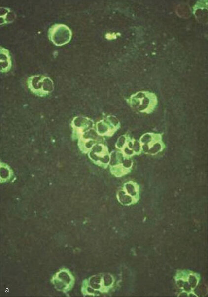 Rycina 1. Identyfikacja przeciwciał przeciwko cytoplazmie neutrofilów (ANCA) metodą immunofluorescencji pośredniej. (a) ANCA typ cytoplazmatyczny: dodatnie znakowanie w cytoplazmie neutrofilów z obecnością ziarnistości i immunofluorescencją pomiędzy segmentami jąder komórkowych. (b) ANCA typ okołojądrowy: immunofluorescencja widoczna wokół jąder neutrofilów.