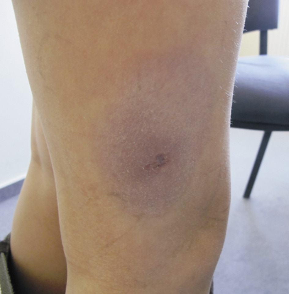 Fot. 5. Chłoniak z komórek dendrytycznych.