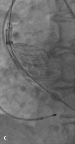 Rycina 3. Kolejne etapy implantacji zastawki CoreValve™.