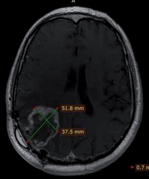 1. Badanie MRI bezpośrednio przed leczeniem.