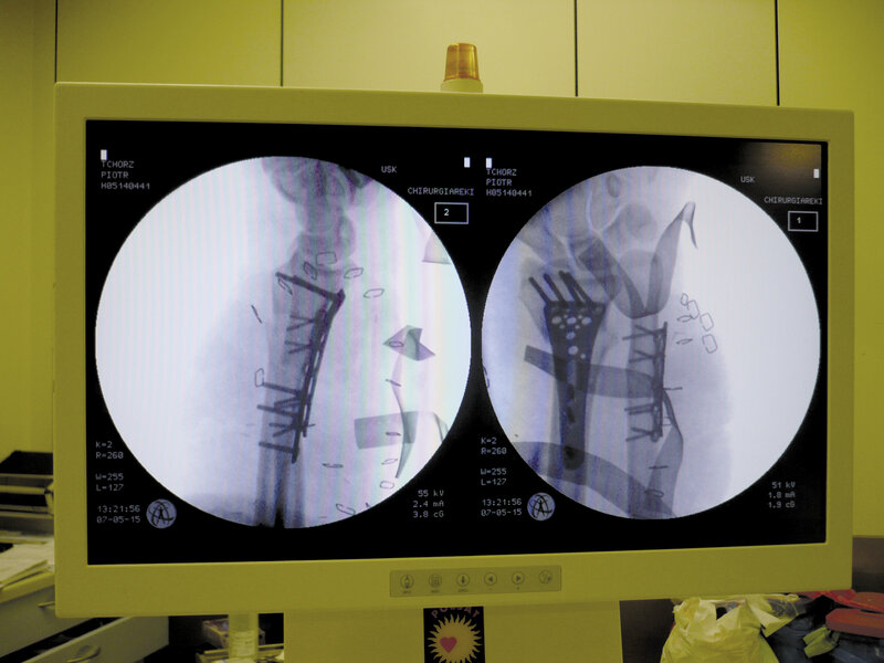 Ryc. 5. Radiologiczny obraz zespolenia kostnego.
