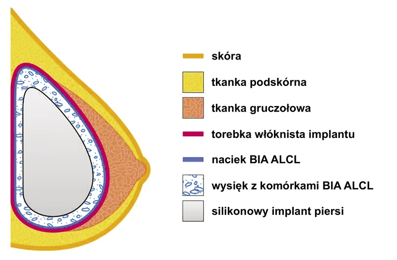 Ryc. 1. Seromat wokół implantu piersi i naciek BIA ALCL w modyfikacji własnej na podstawie [2].