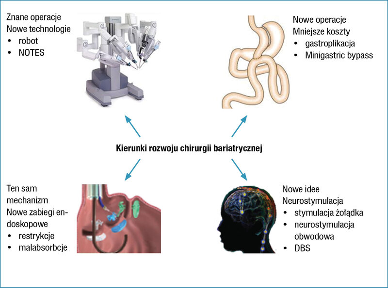 
 
 Rycina 1. Kierunki rozwoju chirurgii bariatrycznej