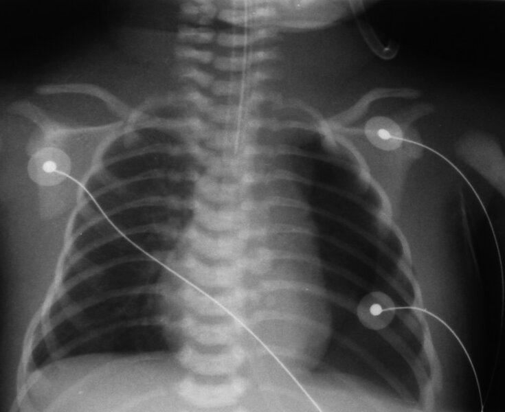 Rycina 1. Badanie radiologiczne klatki piersiowej pokazuje całkowite zapadnięcie płuca lewego.