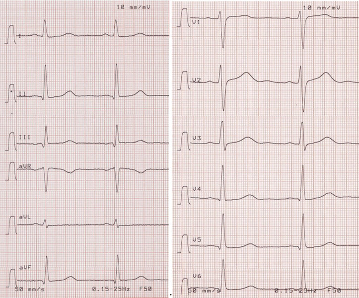 Rycina 12. EKG osiemnastolatka.