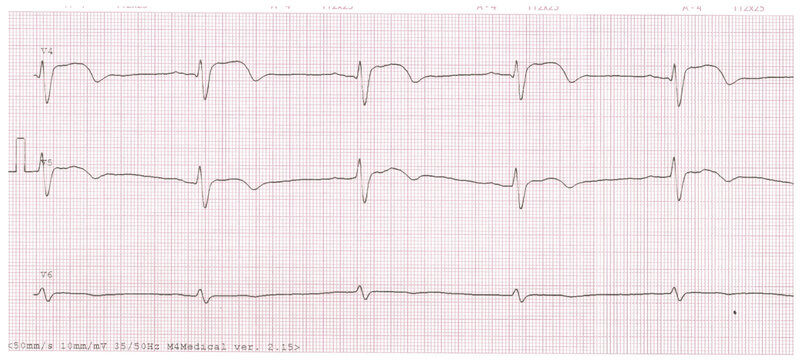 Rycina 1. Elektrokardiogram pacjenta z zawałem mięśnia sercowego z uniesieniem odcinka ST (STEMI) ściany przedniej. Przesuw 50 mm/s. Rytm zatokowy, 63/min, lewogram, blok przedniej wiązki lewej odnogi pęczka Hisa, cechy martwicy w obrębie ściany przedniej, ostry zespół wieńcowy z uniesieniem odcinka ST ściany przedniej (2 doba zawału). W odprowadzeniach V4-V5 pojawiają się ujemne załamki T