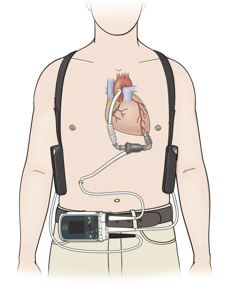 Rycina 2. Pompa HeartMate 2™ – pompa i elementy stale noszone przez chorego. Dzięki uprzejmości St. Jude Medical Inc.