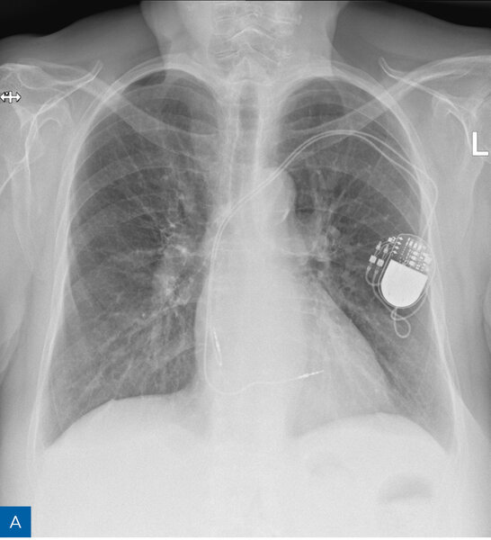 Rycina 1. Obraz radiologiczny w procesie identyfikacji kardiologicznego urządzenia wszczepialnego (CIED). A. Rozrusznik dwujamowy. B. Kardiowerter-defibrylator dwujamowy. C. Kardiowerter-defibrylator podskórny. D. Urządzenie do terapii resynchronizującej z funkcją defibrylacji E. Pętlowy rejestrator zdarzeń oraz rozrusznik dwujamowy. F. Stymulator bezelektrodowy typu Micra. G. Stymulator bezelektrodowy Abbott AVEIR. H. Układ poprawiający kurczliwość mięśnia sercowego (strona prawa) oraz kardiowerter-defibrylator jednojamowy (strona lewa)