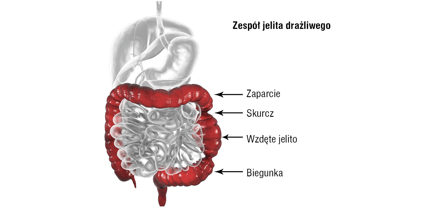 Zespół jelita drażliwego