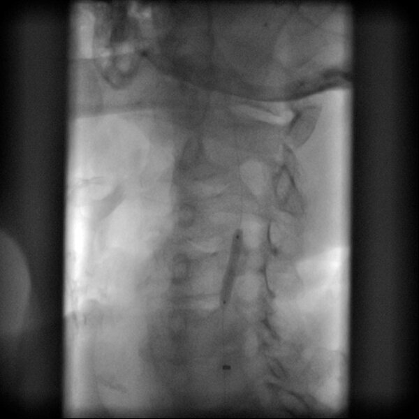 Ryc. 4. Wstępne poszerzenie ciasnego zwężenia tętnicy szyjnej wąskim balonem (predylatacja).
