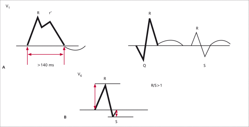 RYCINA 1. Morfologia zespołów QRS zbliżona do RBBB – cechy częstoskurczu komorowego.