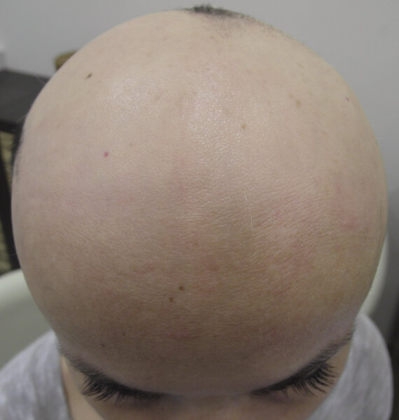 Ryc. 1. Alopecia areata przechodzące w alopecia totalis. Zachowane niewielkie kępki włosów skalpu oraz brwi.