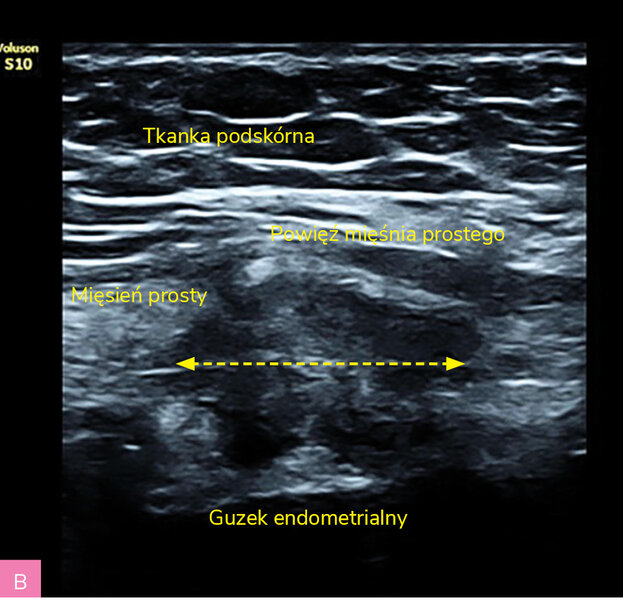 Rycina 1A, B. Obraz ultrasonograficzny zmiany endometrialnej powłok brzucha z typowymi spikularnymi brzegami  (materiał własny autorki)