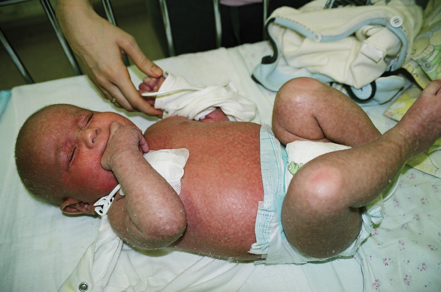 Rycina 2. Erytrodemia u dziecka z ciężkim złożonym niedoborem odporności (w zespole Omenna).