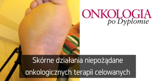 Skórne działania niepożądane onkologicznych terapii celowanych