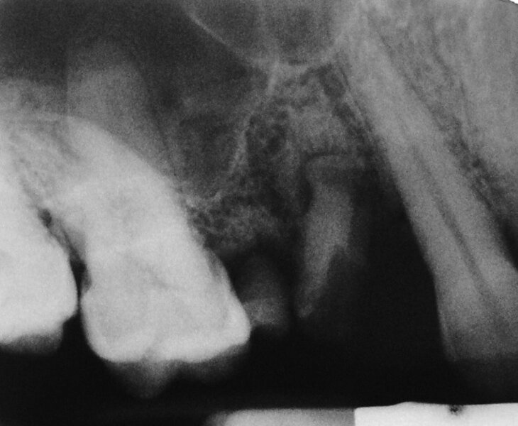 Ryc. 2. Na zdjęciu radiologicznym widoczne  są korzenie zębów 14 i 15 oraz resorpcja kości za zębem 13. 