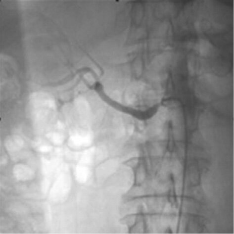 Rycina. Angiogramy nerki. Po stronie lewej – ciężkie zwężenie ujścia prawej tętnicy nerkowej. Po stronie prawej – stan po przezskórnej angioplastyce z implantacją stentu w prawej tętnicy nerkowej.