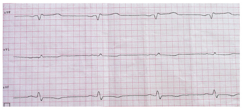 Rycina 2. Elektrokardiogram pacjentki z zawałem mięśnia sercowego bez uniesienia odcinka ST (NSTEMI). Przesuw 50 mm/s. Rytm zatokowy, 60/min, oś pośrednia, cechy martwicy w zakresie ściany przedniej (pacjentka po przebytym OZW-STEMI ściany przedniej), ostry zespół wieńcowy bez uniesienia odcinka ST ściany przedniej, istotne niedokrwienie w obrębie ściany dolnej. Istotne uniesienie odcinka ST w odprowadzeniu aVR – w koronarografii obraz choroby wieńcowej wielonaczyniowej