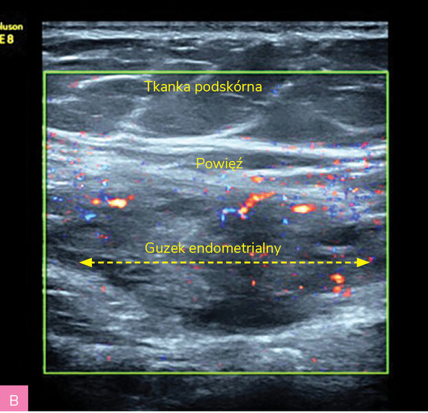 Rycina 2A, B. Obraz ultrasonograficzny zmiany endometrialnej powłok brzucha z typowym obwodowym skąpym unaczynieniem  oraz odczynem wokół zmiany – obwodowe cechy włóknienia = hiperechogenna otoczka wokół guza (materiał własny autorki)