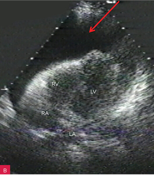 Rycina 7A-D. Tamponada serca z dużą ilością płynu. Obraz „serca tańczącego” u dwóch pacjentów. Projekcje koniuszkowe czterojamowe.  A, B. Pacjent pierwszy, na dwóch kolejnych zdjęciach różne położenie serca balotującego w bardzo dużej ilości płynu (strzałki).  C, D. Pacjent drugi, na dwóch kolejnych zdjęciach różne położenie serca balotującego w dużej ilości płynu (strzałki)