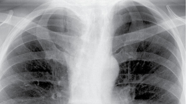 Rycina 1. Zdjęcie radiograficzne płuc, projekcja PA