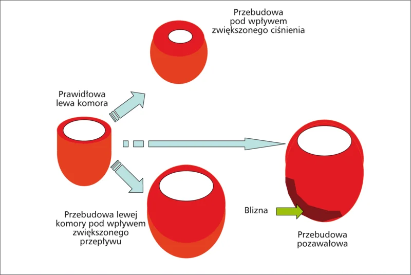 Rycina 3. Typy przerostu lewej komory występujące u chorych z PChN.