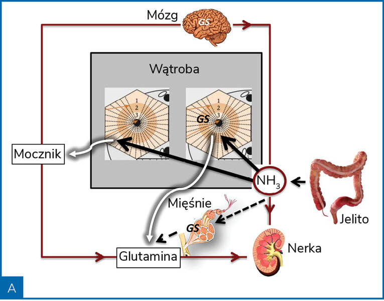 Rycina 2. Poglądowa rycina przedstawiająca metabolizm amoniaku (NH3) w warunkach zdrowia (A) i marskości wątroby (B)