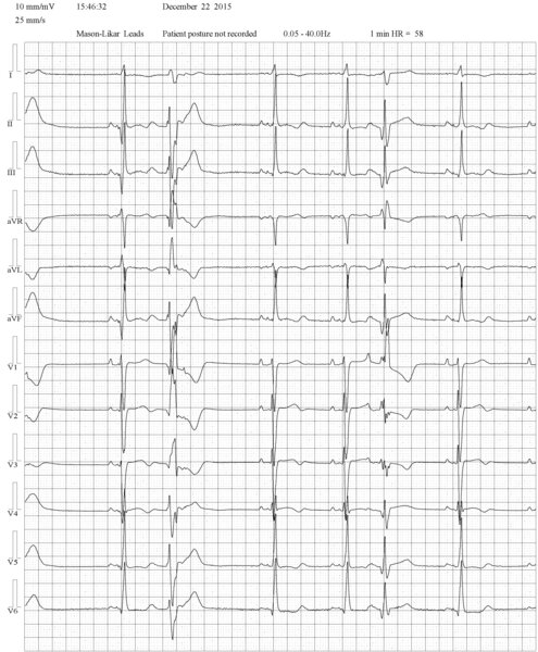 Rycina 4. Pierwsze pobudzenie przedwczesne jest pochodzenia komorowego – widoczny jest wsteczny załamek P z RP >100 ms, jest ujemny w II, III, aVF. Pobudzenie ma obraz RBBB z qR w V1, r <S w V6, czas trwania około 180 ms. Drugie pobudzenie, również o morfologii RBBB, jest pobudzeniem przedsionkowym z widocznym P’ (zwłaszcza w V1 i V2), morfologią rR’ w V1 (a właściwie typu R z głębokim zazębieniem na ramieniu wstępującym zespołu) oraz R >S w V6, czas trwania 150-160 ms 