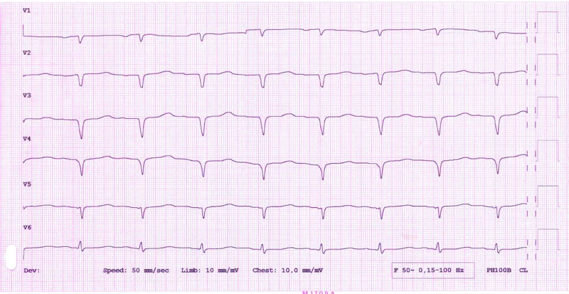 Rycina 2. EKG z niskim woltażem (<0,5 mV) załamków QRS w odprowadzeniach kończynowych – obraz, który może sugerować płyn w jamie osierdzia.