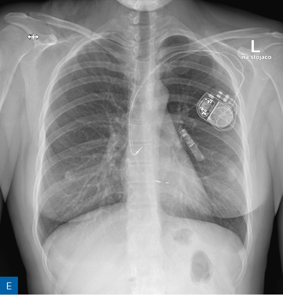 Rycina 1. Obraz radiologiczny w procesie identyfikacji kardiologicznego urządzenia wszczepialnego (CIED). A. Rozrusznik dwujamowy. B. Kardiowerter-defibrylator dwujamowy. C. Kardiowerter-defibrylator podskórny. D. Urządzenie do terapii resynchronizującej z funkcją defibrylacji E. Pętlowy rejestrator zdarzeń oraz rozrusznik dwujamowy. F. Stymulator bezelektrodowy typu Micra. G. Stymulator bezelektrodowy Abbott AVEIR. H. Układ poprawiający kurczliwość mięśnia sercowego (strona prawa) oraz kardiowerter-defibrylator jednojamowy (strona lewa)