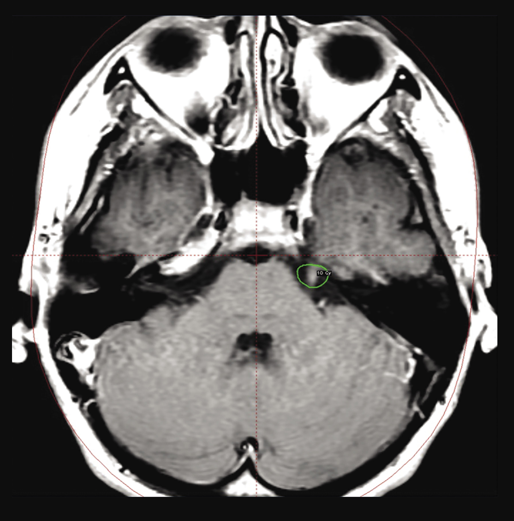 Rycina 2. Kontrolny rezonans magnetyczny po leczeniu radiochirurgicznym gamma knife pacjenta z neuralgią nerwu trójdzielnego lewego. Widoczny jest obszar wzmocnienia kontrastowego w zakresie pnia nerwu trójdzielnego  po 6 miesiącach od napromieniania