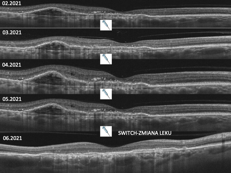 Rycina 3. OCT przy braku odpowiedzi na fazę wysycającą leczenia; dzięki zmianie leku natychmiastowa poprawa parametrów anatomicznych siatkówki (regresja PED, płynu pod- i śródsiatkówkowego)