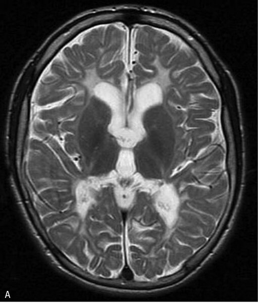 Rycina 3. Leukodystrofia hipomielinizacyjna typu 7 (HLD7) z hipodoncją i hipogonadyzmem hipogonadotropowym. A. MR, sekwencja T2. Hipomielinizacja oraz zmniejszona objętość całej istoty białej półkul mózgu. B. Ścieńczałe ciało modzelowate, widoczny również zanik móżdżku. Chłopiec 10-letni z powoli postępującym zespołem pozapiramidowo-piramidowym i ataksją
