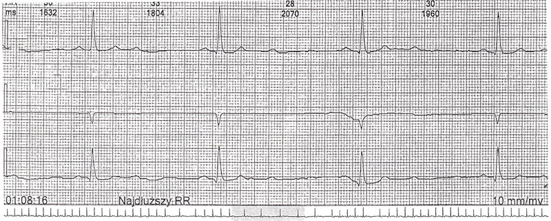 Rycina 2. Fragment zapisu z badania EKG metodą Holtera. Epizody bloku przedsionkowo-komorowego II° typu Mobitz II rejestrowane jedynie podczas snu u pacjenta z ciężkim obturacyjnym bezdechem sennym