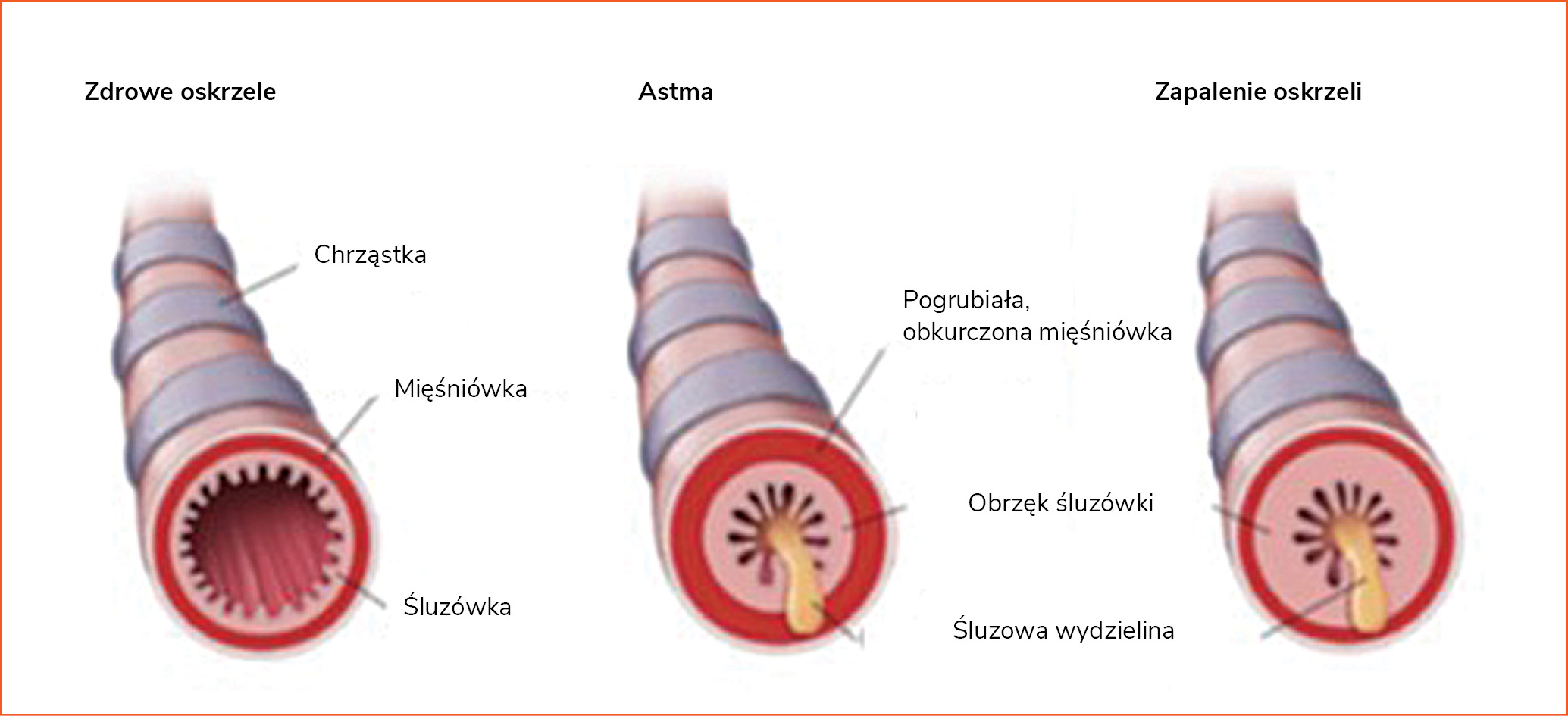 Rycina 1. Mechanizm powstawania obturacji w astmie i zapaleniu oskrzeli