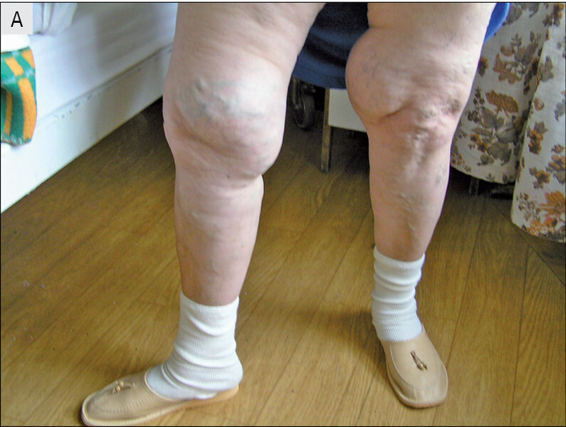 Rycina 7 A i B. Lipoedema.