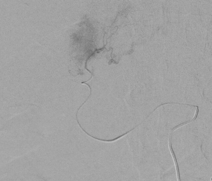 Ryc. 1. Wybiórcza arteriografia wykonana z mikrocewnika bezpośrednio do guza.