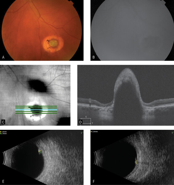 Rycina 1. (A) Obraz dna oka lewego – zmiana naczyniówki poniżej arkady skroniowej dolnej, (B) obraz autofluorescencji, (C, D) obraz OCT, (E, F) ultrasonografia wykazująca obecność hiperreflektywnej zmiany z towarzyszącym cieniem akustycznym o wymiarach 2,15 × 2,04 mm i wysokości 1,45 mm